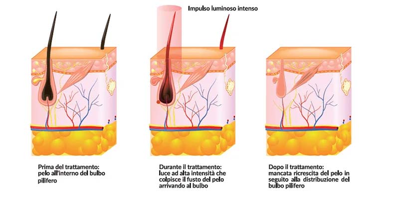 iEpil ICE Skin Diagrams